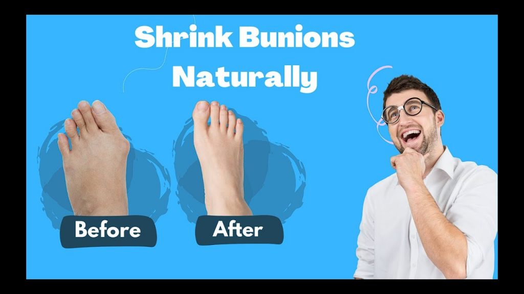 How to Shrink Bunions naturally