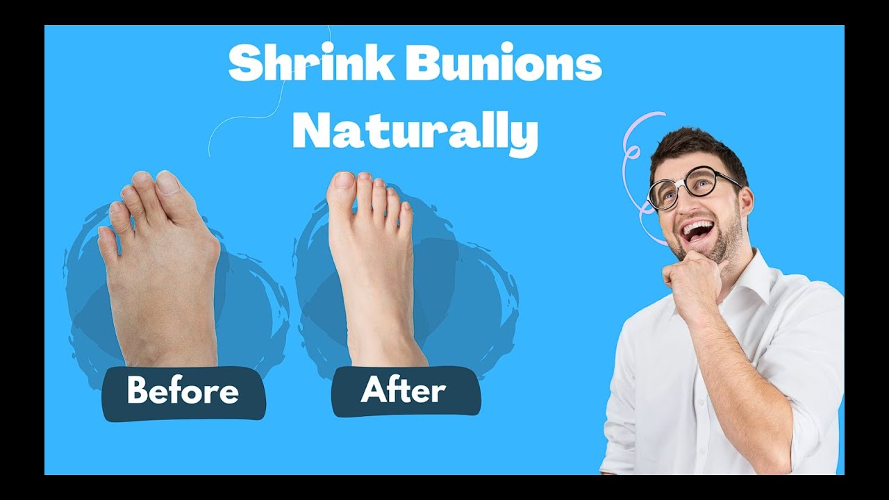 How to Shrink Bunions naturally