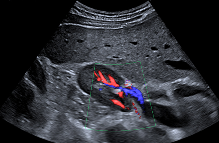 Ultrasound for Kidneys and Bladder